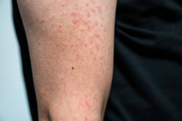 피부염 발진 바이러스 성 질병 면역 결핍 젊은 성인 아시아의 팔에, 가려움증으로 스크래치 - immunodeficiency 뉴스 사진 이미지