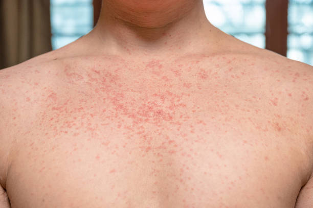 dermatite rash malattia virale con immunodeficienza sul corpo di giovani adulti asiatici, graffio con prurito - immunodeficiency foto e immagini stock