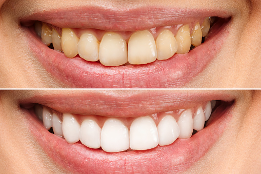 dientes de la mujer antes y después del blanqueamiento. Sobre fondo blanco. Paciente de clínica dental. La imagen simboliza la odontología de cuidado bucal, la estomatología photo