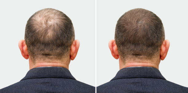 머리 이식 수술 전후 대머리 남자의 머리. 머리카락을 잃은 남자가 털이 되었습니다. 헤어 이식 클리닉의 광고 포스터입니다. 대머리의 치료 - 탈모 뉴스 사진 이미지
