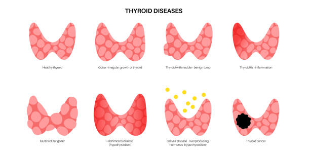 thyroid gland disease Thyroid gland diseases. Endocrinology clinic concept. Cancer, thyroiditis, goiter, hypothyroidism and hyperthyroidism. Pain and inflammation in human neck. Human endocrine system vector illustration thyroid disease stock illustrations