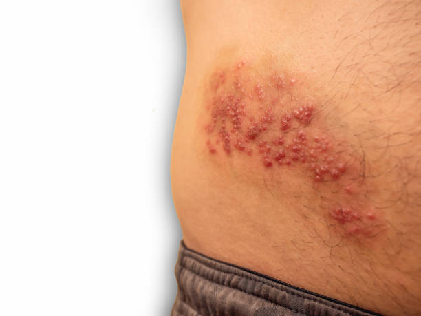 Shingles outbreak on torso. The varicella-zoster virus has formed a red rash with fluid-filled blisters on the belly. Shingles or herpes zoster are skin blisters caused by the varicella-zoster virus. A viral infection that causes a painful rash or blisters to appear on the skin. Shingles on the belly or torsos. shingles rash stock pictures, royalty-free photos & images