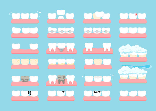 aparaty ortodontyczne, implantowe, krzywe i z licówką nazębną w dziąśle izolowane na tle. - human teeth gums dental hygiene inflammation stock illustrations