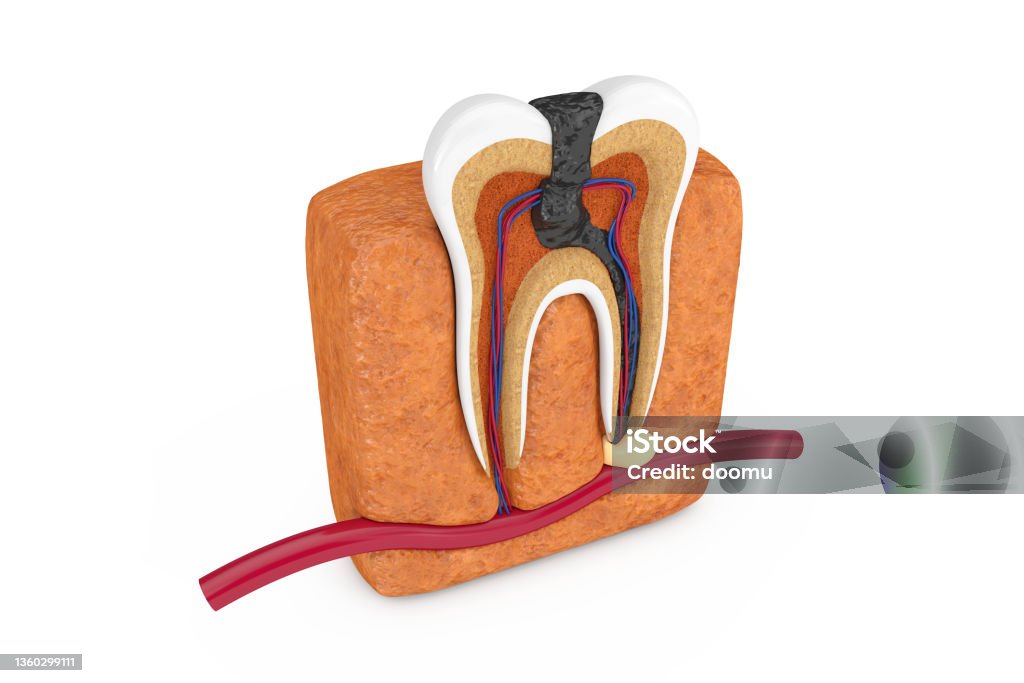 Inside of Decay Tooth. 3d Rendering Inside of Decay Tooth on a white background. 3d Rendering Anatomy Stock Photo