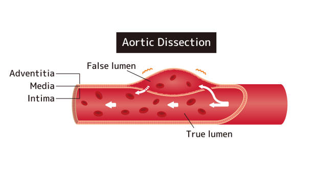 bildbanksillustrationer, clip art samt tecknat material och ikoner med vector illustration of aortic dissection - aorta