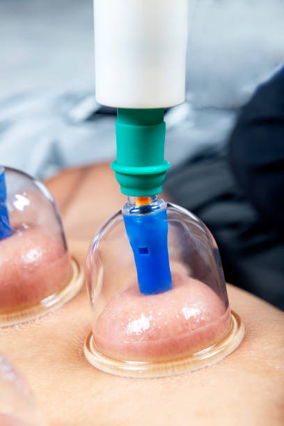 istock Man with cupping treatment on the back 1360507796