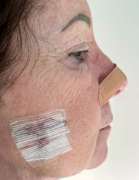 serie-medical: chirurgia di mohs sul viso di una donna anziana - plastic surgery bandage surgery women foto e immagini stock