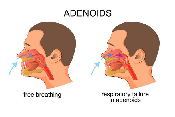 adenoiditis, respiratory failure Vector illustration of the growth of adenoids, adenoids, breathing problems. adenoiditis tonsil stock illustrations