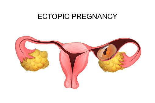 illustration of uterus with ectopic pregnancy. gynecology