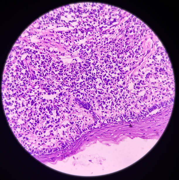 istock Pyriform fossa cancer: Invasive squamous cell carcinoma, moderately differentiated, show malignant neoplasm 1360652091