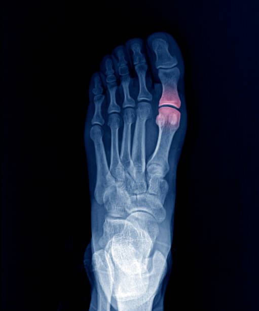 röntgenaufnahme der ferse nach calcaneus fraktur stock foto - bending human foot ankle x ray image stock-fotos und bilder