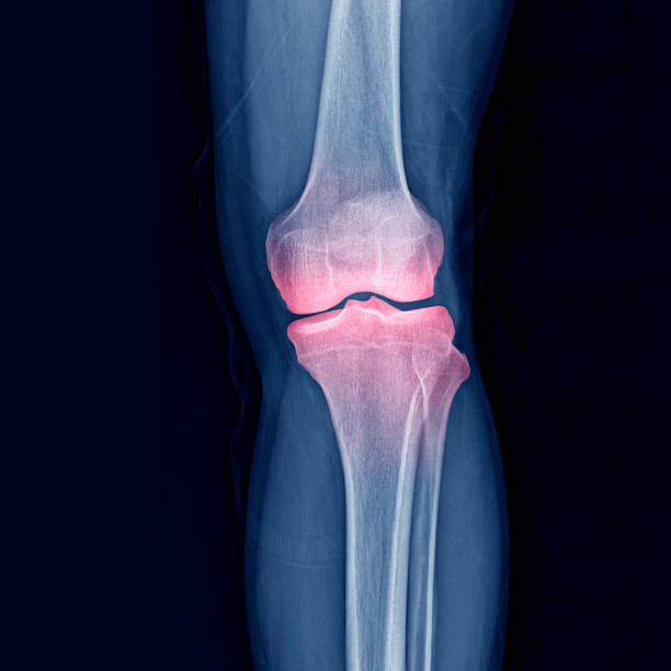 Sporting injury stock photo A cgi view of an inflamed joint isolated on blue knee photos stock pictures, royalty-free photos & images