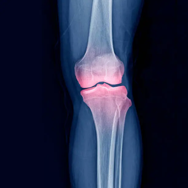 A cgi view of an inflamed joint isolated on blue