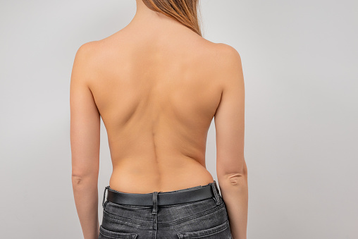 Mujer con escoliosis de la columna vertebral. Espalda curvada de la mujer. photo