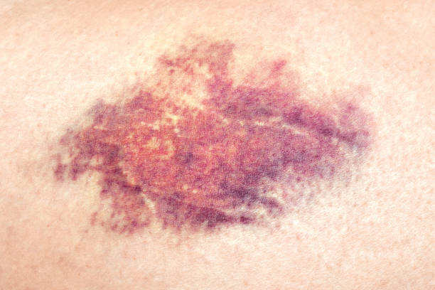 close-up de uma contusão na pele ferida da perna de uma mulher. - equimose - fotografias e filmes do acervo