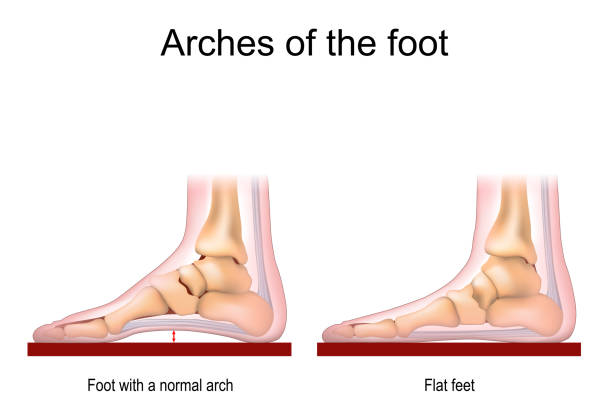 Foot with a normal arch and Flat feet. vector art illustration