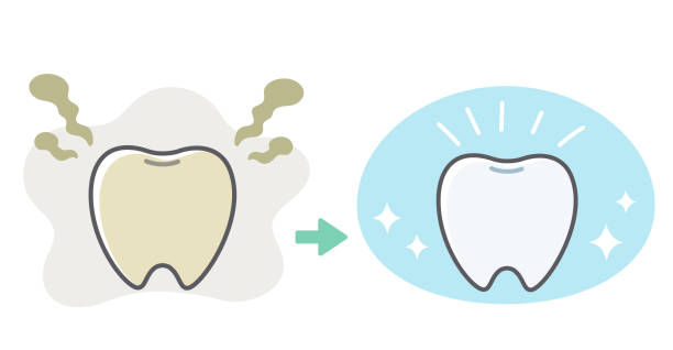 illustrazioni stock, clip art, cartoni animati e icone di tendenza di bifore di miglioramento bifore della carie dentale - sbiancamento dentale