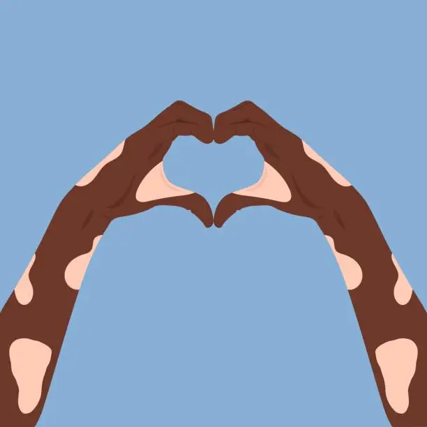 Vector illustration of anti-racism concept vector hands making heart sign, vitiligo skin concept illustration stock