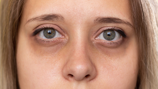 Cropped shot of a young woman's face. Green eyes with dark circles under the eyes and with red capillaries. Bruises under the eyes are caused by fatigue, nervousness, lack of sleep, insomnia and stress