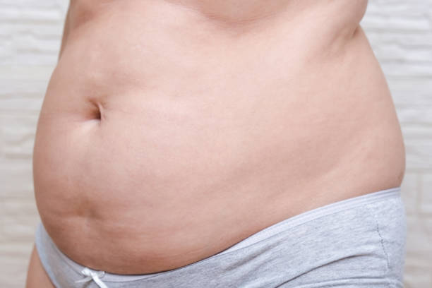 pancia obesa di donna adiposa sovrappeso, eccesso di grasso e pelle sullo stomaco - fulness foto e immagini stock