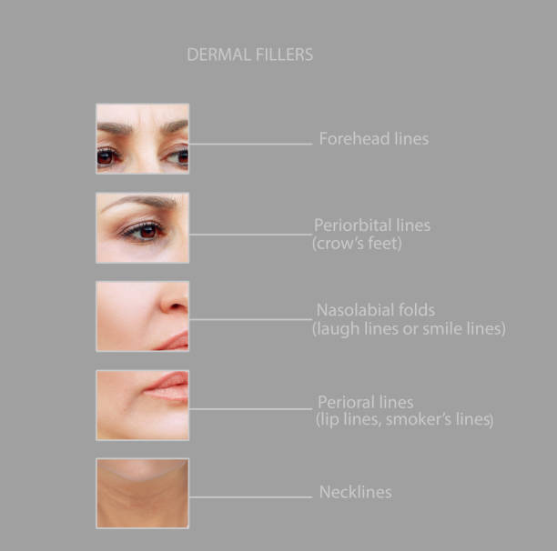 dermal filler treatments .Hyaluronic acid injections for specific areas.Correct wrinkles. dermal filler treatments .Hyaluronic acid injections for specific areas.Correct wrinkles. botox before and after stock pictures, royalty-free photos & images