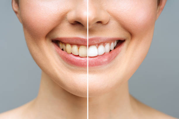 denti da donna prima e dopo lo sbiancamento. su sfondo bianco. paziente in clinica dentale. l'immagine simboleggia l'odontoiatria delle cure orali, la stomatologia - human teeth whitening dentist smiling foto e immagini stock