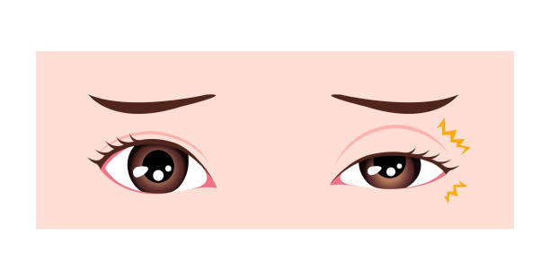 Causes of myokymia (eyelid twitch or tic) vector illustration Causes of myokymia (eyelid twitch or tic) vector illustration tetanospasmin stock illustrations