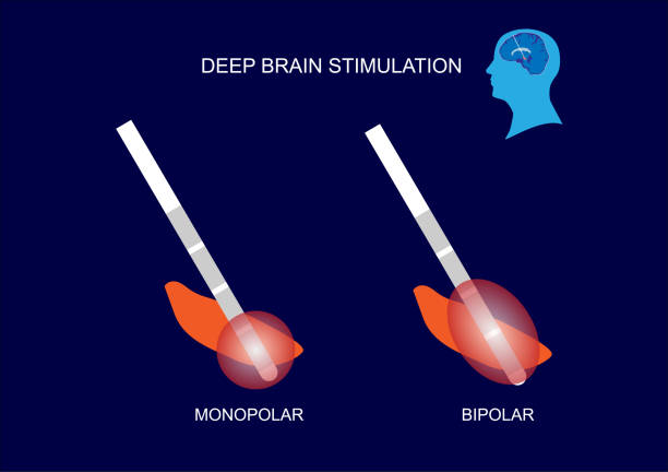 tryb stymulacji mózgu dbs w chorobie parkinsona - electrode stock illustrations