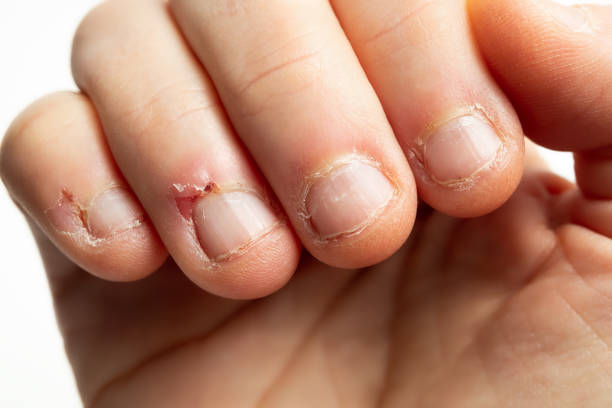 fingers with signs of nail biting. - nail biting imagens e fotografias de stock