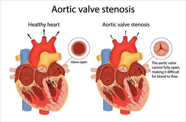 illustrations, cliparts, dessins animés et icônes de l’illustration médicale montre la différence entre une valve aortique normale et une valve sténosée. illustration de style bande dessinée - valvule humaine