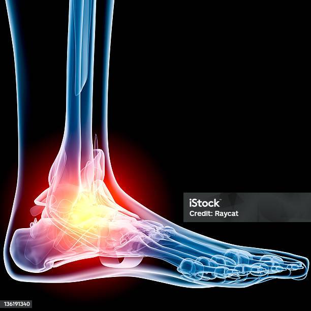 Ankle In Pain Xray Stock Photo - Download Image Now - Ankle, Pain, Surgery