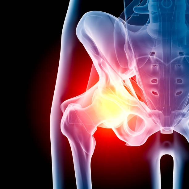 Hip in pain x-ray Digital medical illustration: Anterior (front) x-ray view (orthogonal) of human hip. With pain zone in hip. Featuring: front hip pain stock pictures, royalty-free photos & images