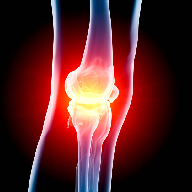 Digital medical illustration: Anterior (front) x-ray view (orthogonal) of human knee. With pain zone in knee. Featuring: