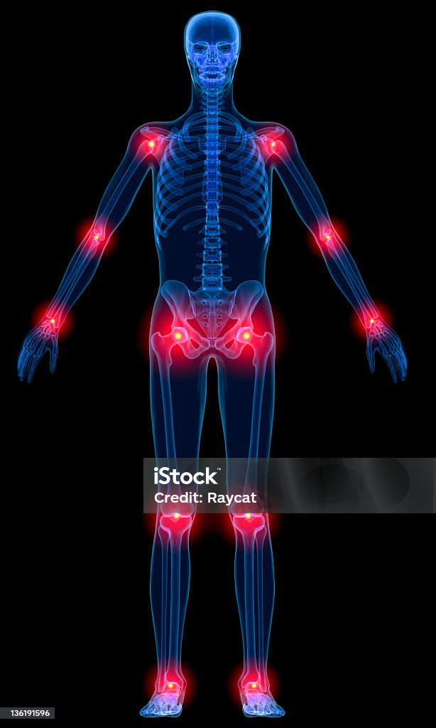 Inflammation Of Joints Stock Photo - Download Image Now - Pain, The Human  Body, Full Length - iStock
