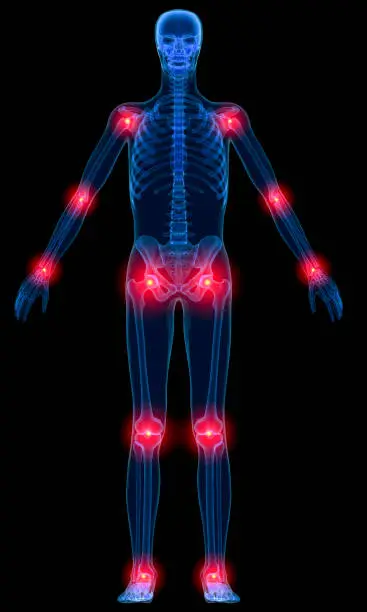 Photo of Inflammation of joints