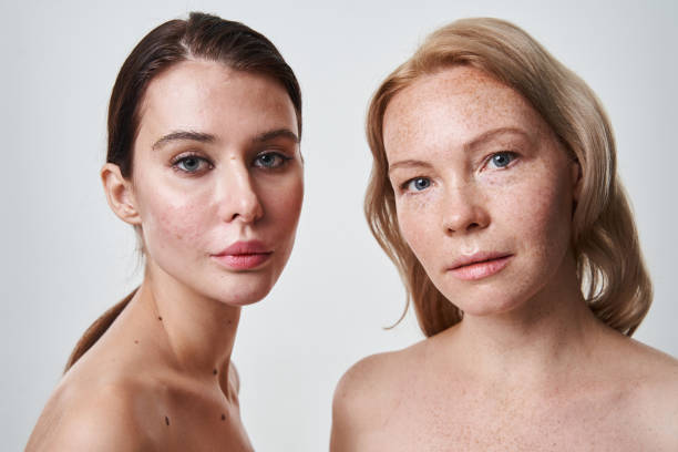 istock One woman with clear fresh skin and another having acne symptoms 1361916082