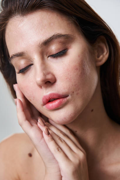 femme brune avec des boutons sur la peau posant les yeux fermés - imperfection photos et images de collection