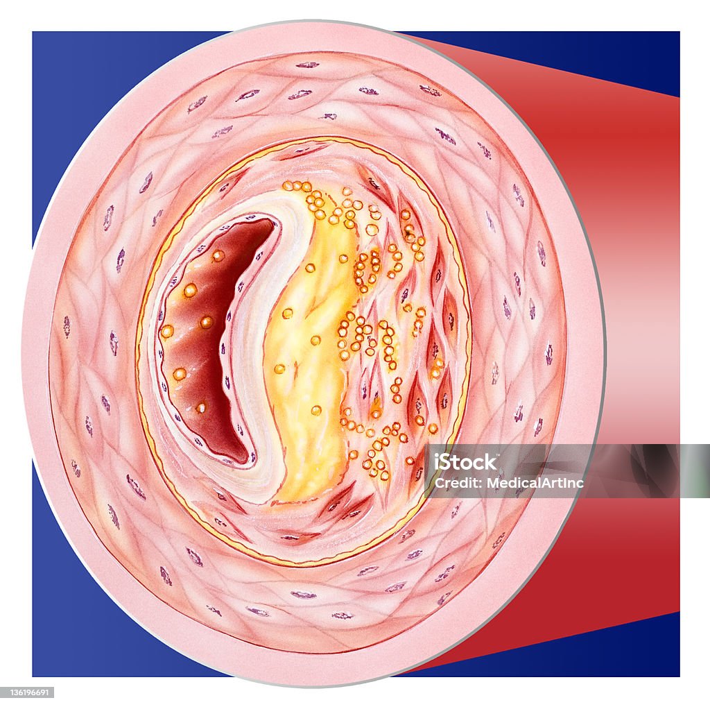 Blut-verstopft Schiff - Lizenzfrei Ruptur einer arteriosklerotischen Plaque Stock-Illustration