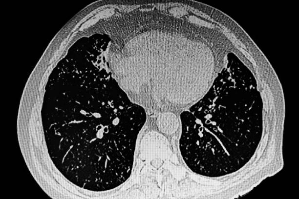 istock X- ray image of small right lung pneumonia. 1361968920