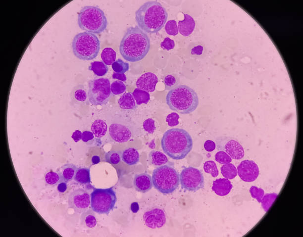 istock Microscopic view of bone marrow slide, megaloblastic anemia, mylodysplastic anemia,  MDS disease 1362033170