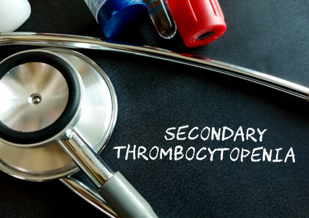 istock Secondary Thrombocytopenia term on black background with medical equipment. 1362208340