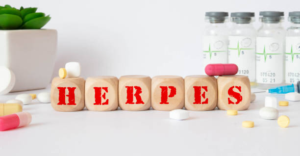 Herpes - word from wooden blocks with letters, viral diseases herpes viruses concept, blue background stock photo