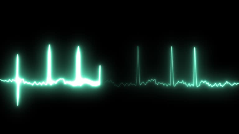 Animation Atria Atrial Fibrillation Animation Gif