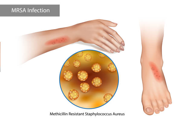 mrsa 슈퍼 버그 감염. 메티실린 내성 황색포도상구균 아우레우스. 포도상 구균에 기인한 팔과 다리에 뾰루지 - staphylococcus aureus stock illustrations