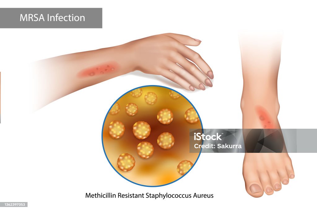 Staph Rashes Mrsa Superbug Infection Methicillin Resistant Staphylococcus Aureus ...