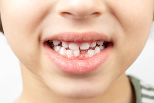 istock Child mouth without one bottom front tooth 1362428173