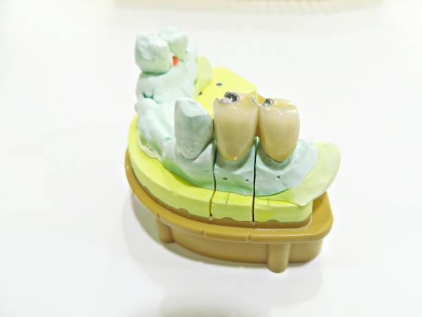 istock Porcelain bridge for denture 1362468445