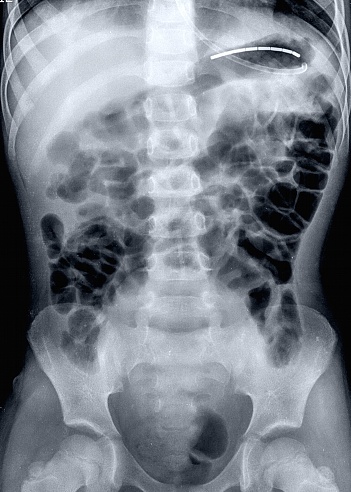 Xray Dari Perut Dan Strukturnya Foto Stok - Unduh Gambar Sekarang ...