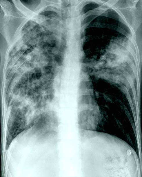radiographie thoracique frontale avec pneumonie compliquée - pathogen streptococcus life science photos et images de collection