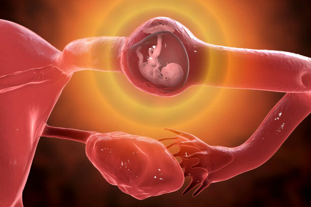 Tubal ectopic pregnancy, 3D illustration stock photo